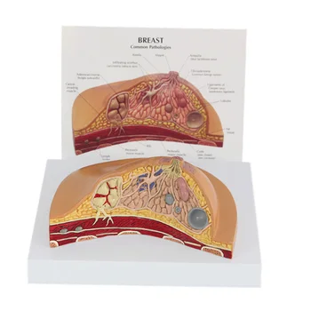 Медицинско заболяване Рак Модел Анатомия на гърдата Модел на човешкото тяло Анатомическая Патологична модел на гърдата